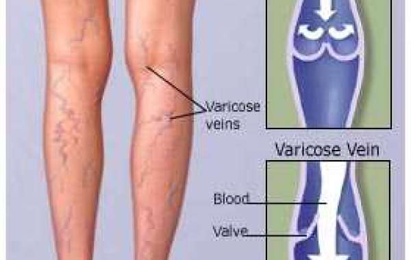 Looking for the best varicose vein treatment in Delhi? your search ends here.
