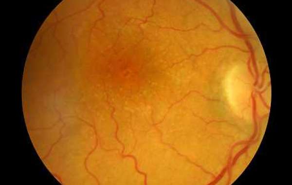 Retinal Vein Occlusion Market 2030| Key Vendor Landscape By Regional Output Demand By Countries And Future Growth