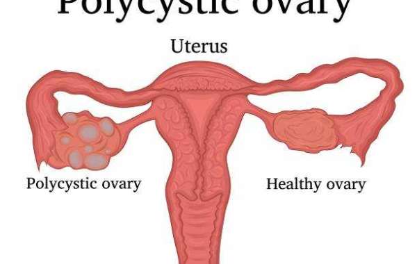 Symptoms, Causes, And Treatment of PCOS