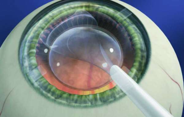 Intraocular Lens Market Share to Benefit from the Technologically Modern Solutions