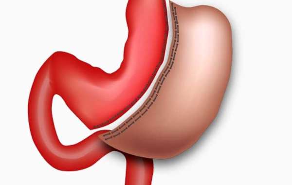 Preparing for Gastric Sleeve Surgery: Eligibility and Precautions