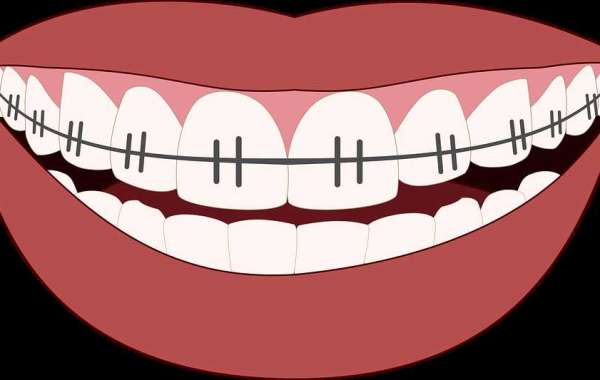 Is the Cost of Braces Well Worth It?