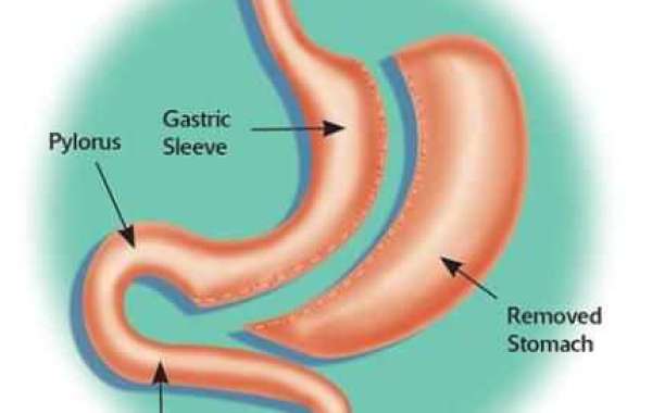 4 FAQs About Gastric Sleeve Surgery Answered by Experts