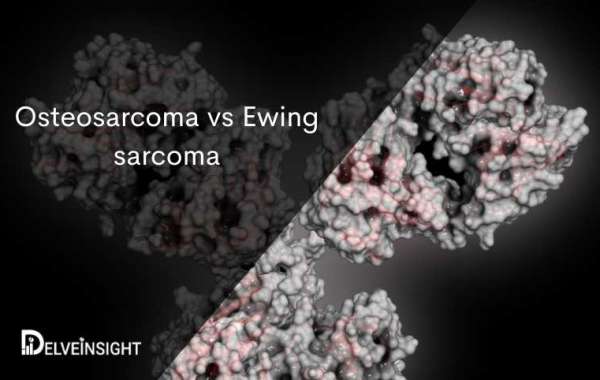 Decoding Ewing Sarcoma and Osteosarcoma: An In-depth Comparative Analysis