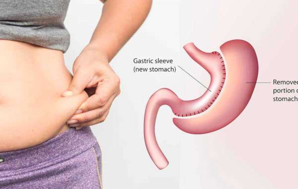 gastric sleeve surgeon - Complete Weight Loss Solution