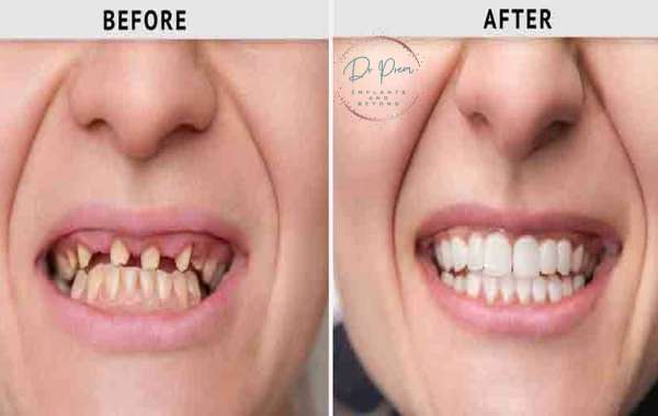 Porcelain Veneers: Transforming Smiles with Precision