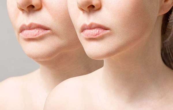 Dermal Fillers: A Closer Look at the Game-Changer in Oahu Cosmetic Enhancement