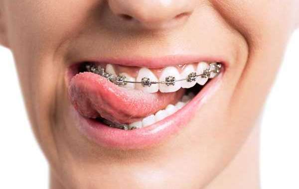 Transform Your Smile with the Best Orthodontist in Bhopal at Smile Gallery Dental Wellness Centre