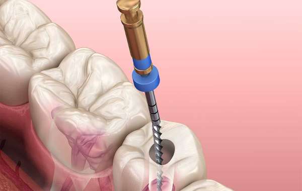 Understanding Root Canal Treatment: Dispelling Myths and Embracing Facts
