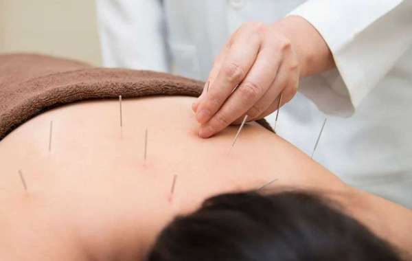 Best TCM Acupuncture