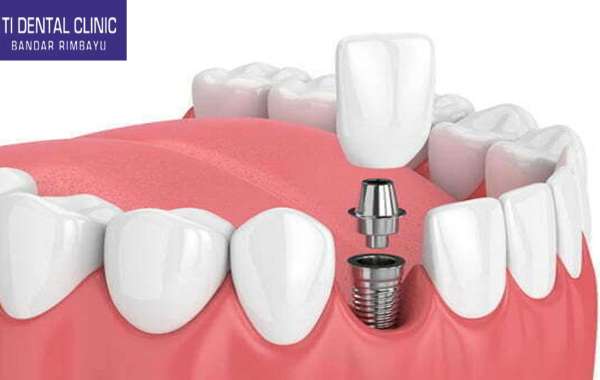 The Evolution of Dental Implants: Innovations in Dentistry (Tidental)