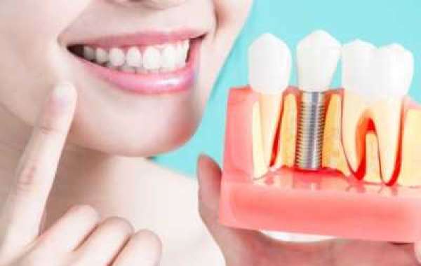 Revolutionizing Smiles The Power of Dental Implants in Hawthorn East