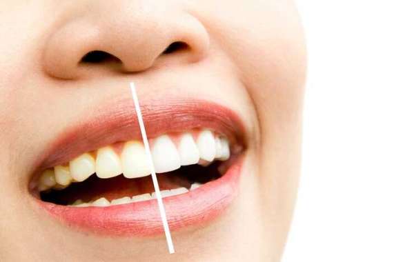 The Importance of Teeth Whitening