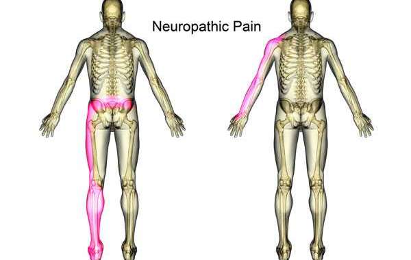 Neuropathic Nerve Pain: Understanding, Managing, and Finding Relief