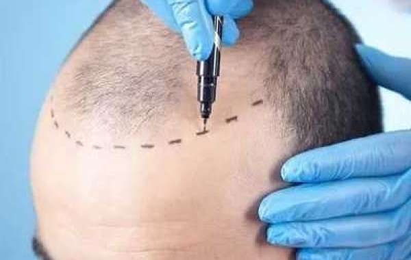 Which treatment is best for hair transplant
