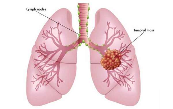 Lung cancer specialist in Delhi
