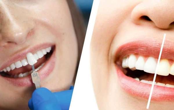 Teeth Whitening Or Dental Veneers?