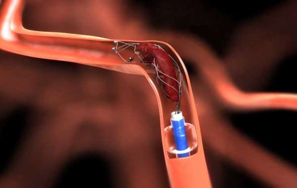 The Neurovascular Devices Market Is Driven By Rising Incidences Of Neurovascular Disorders
