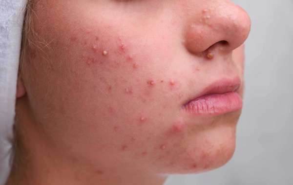 Revitalize Your Skin: Acne Scar Treatment in Delhi at Skin Roots Clinic