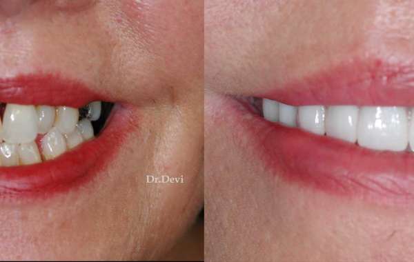 Discovering the Revolutionary Solution: All-on-Four Dental Implants