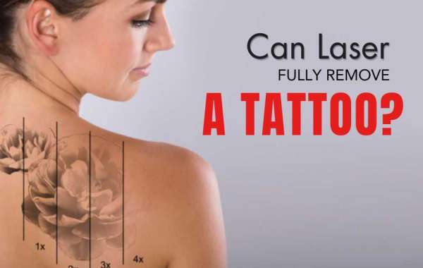Can Laser fully remove a tattoo?