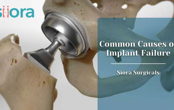 Common Causes of Implant Failure