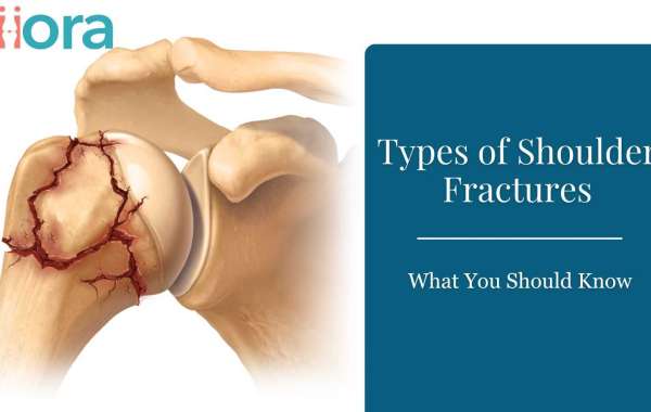 Types of Shoulder Fractures - What You Should Know
