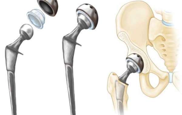 Hip Replacement Market: Revolutionizing Treatment Options for Hip Disorders