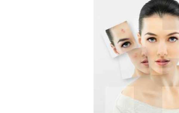 Achieving Radiant Skin: Pigmentation Removal in Victoria, BC