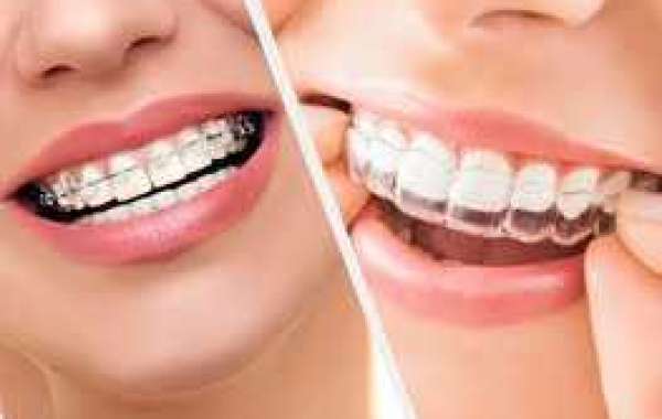 Finding the Best Dentist for Braces in Bangalore: Your Guide to a Perfect Smile