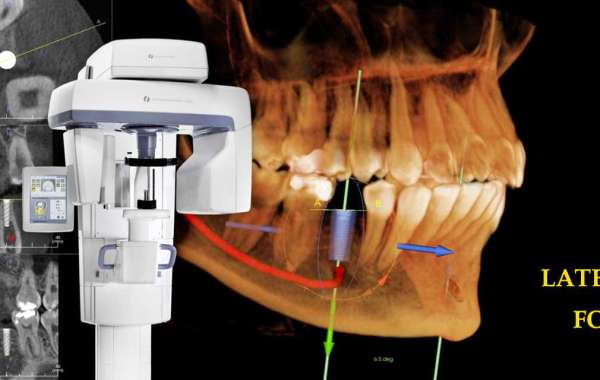 Restoring Smiles: A Comprehensive Guide to Dental Implants