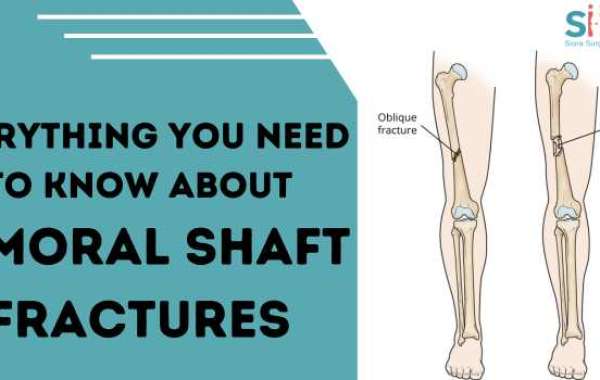 Everything You Need to Know About Femoral Shaft Fractures