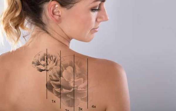 How Does PicoSure Tattoo Removal Work? 10 Things to Know