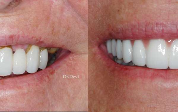 Denture Implants: The Ultimate Solution for a Confident Smile