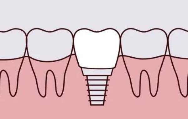 Understanding the Different Types of Dental Implants