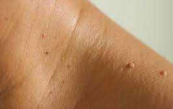 Skin Tag Removal Dermatologist