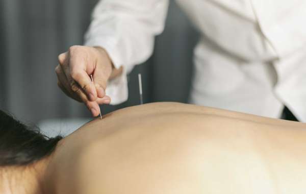 Experience the Healing Benefits of Acupuncture at Hannah Integrative Health in Newport Beach, CA