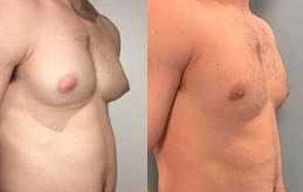 Fix Chest Fat with Male Breast Reduction: