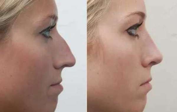 Refine Your Look Without Surgery: Discover the Power of Liquid Rhinoplasty at Ageless By Ezzo